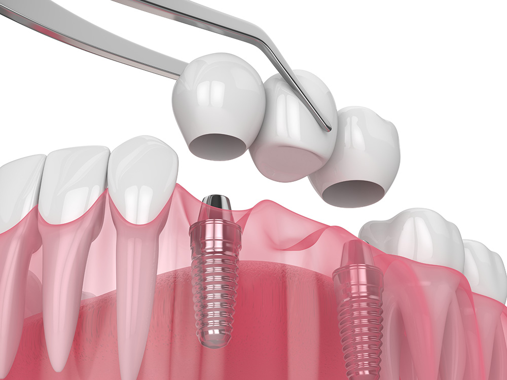 Мост на жевательные зубы на двух имплантах