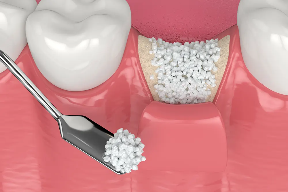 Трехмерная визуализация прививки зубной кости с применением биоматериала кости.