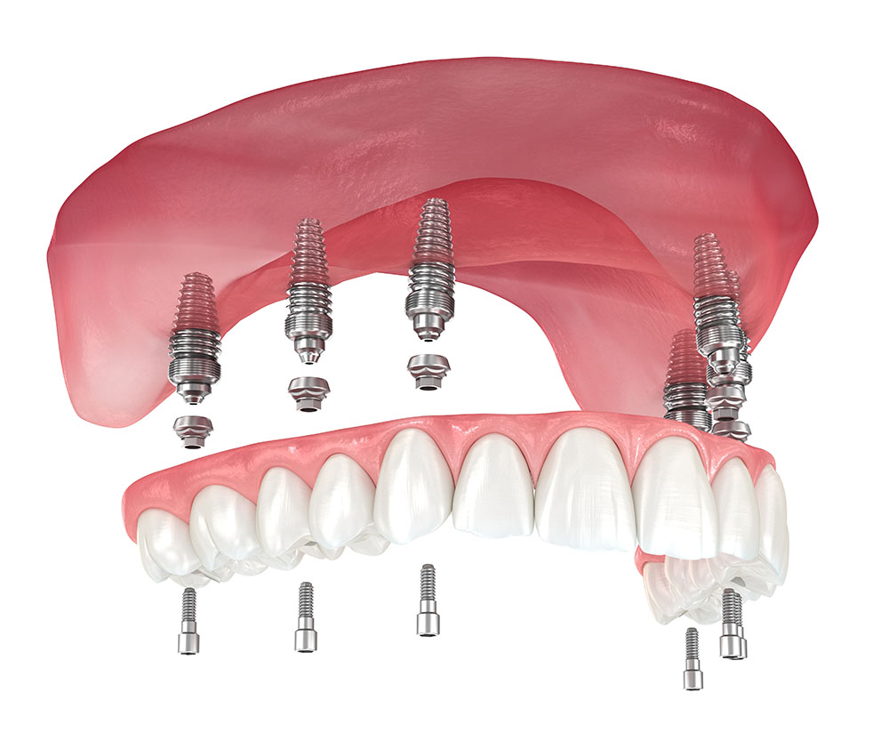 Полный несъемный протез на имплантах на верхние зубы по методике All-on-six