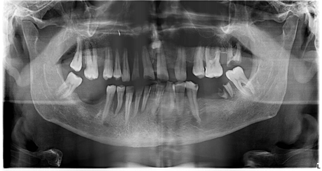 Атрофия кости нижней челюсти
