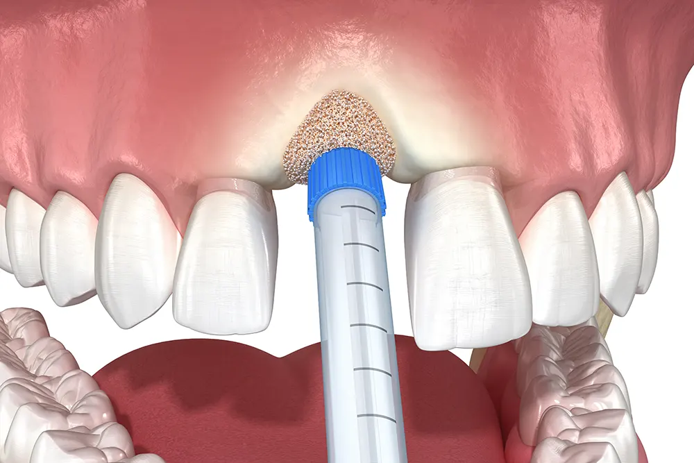 Увеличение костной трансплантации при имплантации зубов