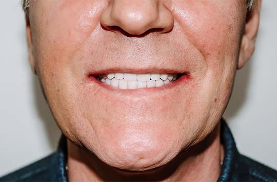 Восстановленный вид зубного ряда после применения скуловой имплантации и All-on-4