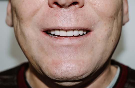 Полностью восстановленный зубной ряд верхней и нижней челюсти