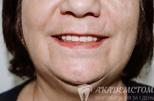 Пациентка снова может широко улыбаться благодаря протезированию