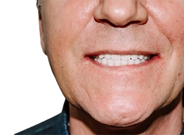 Фото зубного ряда после несъемного протезирования