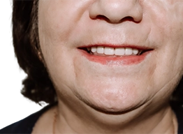 Снимок челюсти пациента с новыми протезами