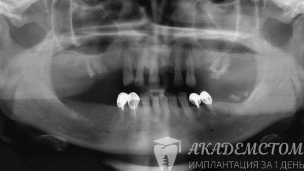 Снимок челюстей до имплантации