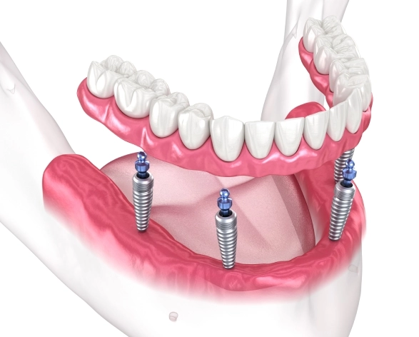 Имплантация зубов All-on-4