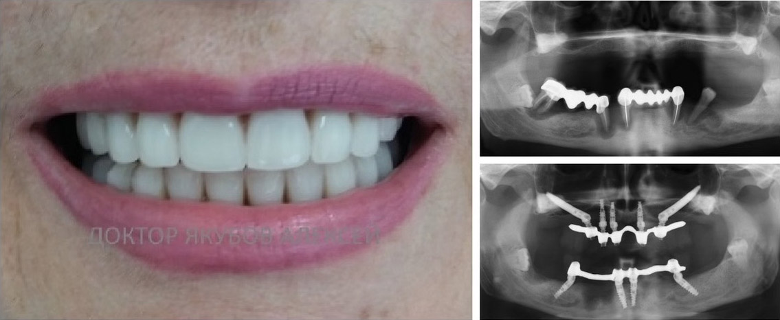 Фото зубов на имплантах верхней челюсти