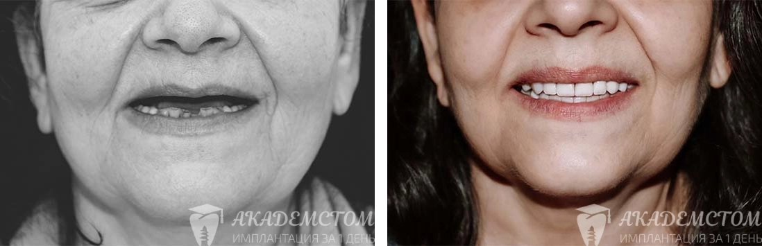 Фото до и после полной имплантации обеих челюстей в клинике «Академстом»