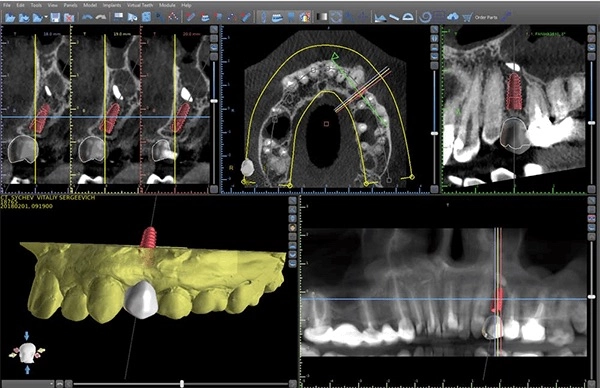 Для того, чтобы имплантация прошла быстро и наиболее безболезненно делается 3D-моделирование челюсти пациента