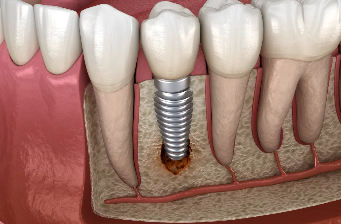 Разрушение костной ткани на стадии периимплантита