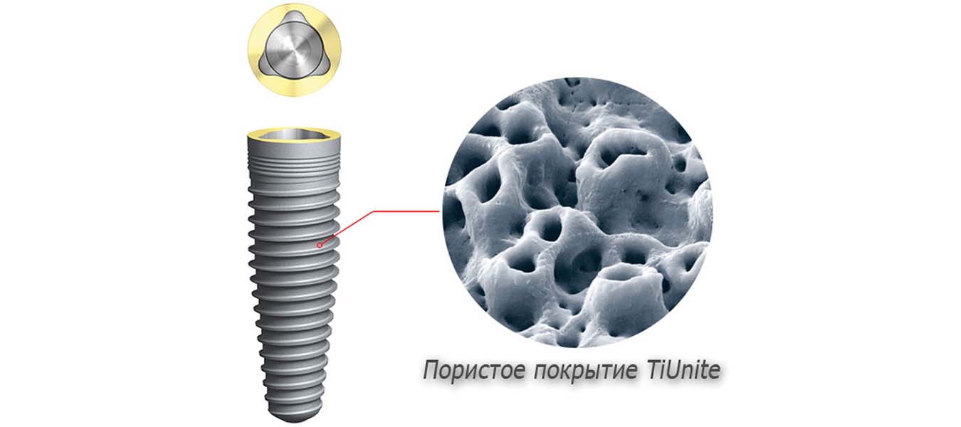 Импланты Nobel Biocare имеют покрытие TiUnite с повышенным содержанием фосфора