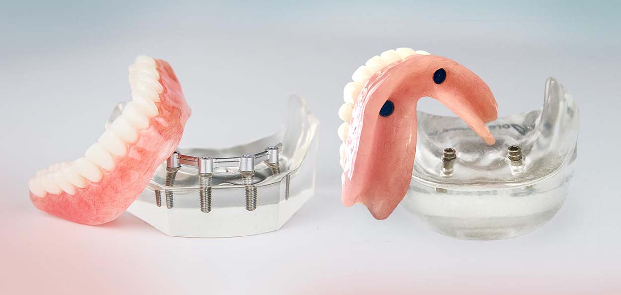 Акриловые протезы на имплантах для временного протезирования челюсти пациента