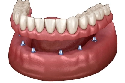 Применение имплантации по методу All-on-6 на примере 2D модели нижней челюсти