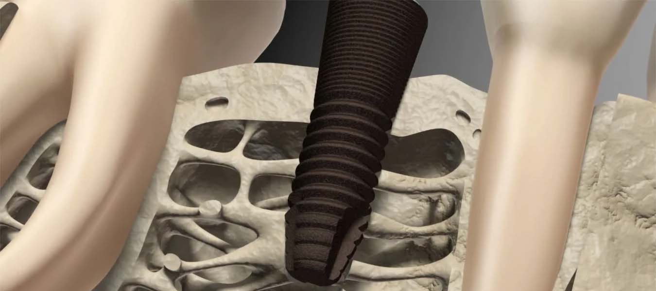 Остеоинтеграция — срастание имплантата с костной тканью
