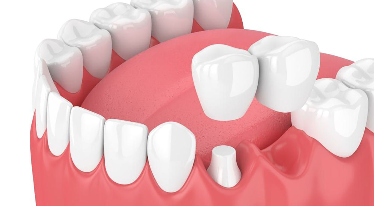 Можно ли установить мостовидный протез на один зуб?