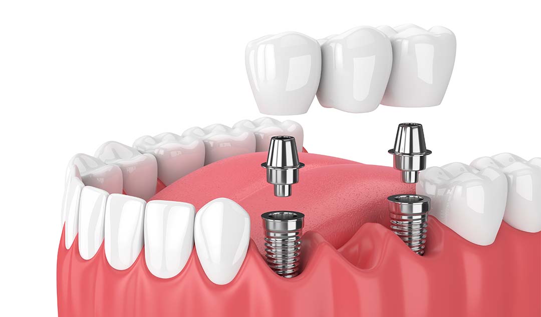 Как ухаживать за зубными мостами на имплантах