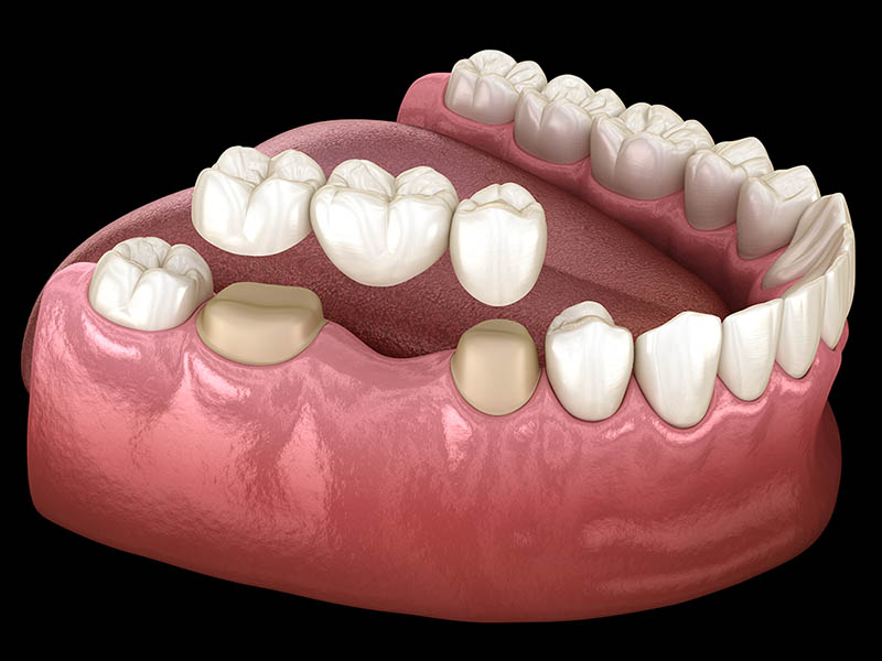 Мостовидный протез на зубы 3d-модель