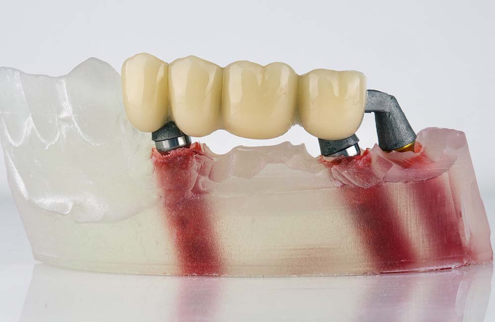 Мост на 3 имплантах в жевательном отделе при отсутствии 4 зубов