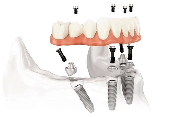 Ортопедическая конструция для нижней челюсти устанавливается на четыре титановых стержня