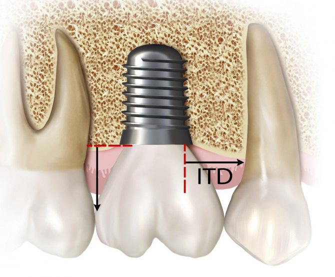 Маленькое расстояние от импланта до соседних зубов может привести к периимплантиту
