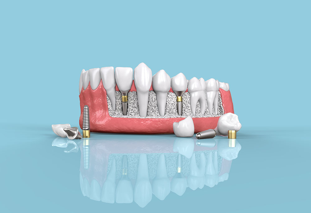 Разные зубные импланты
