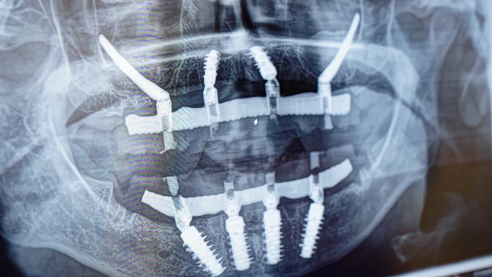 рентгеновский снимок скуловой имплантации