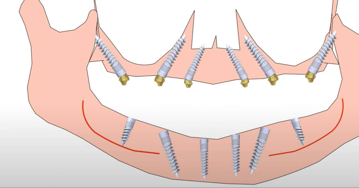 Установка базальных имплантов по All-on-6 на две челюсти