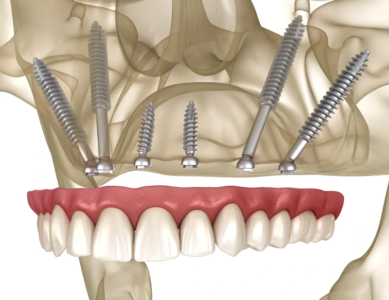 Установка базальных имплантов по All-on-6 на две челюсти