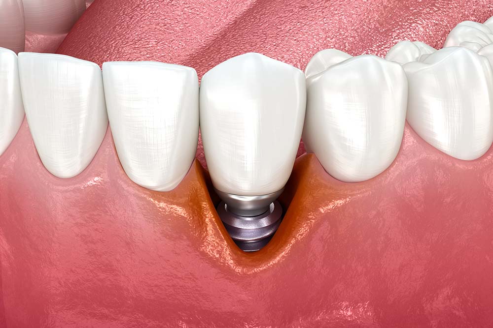 Из-за плхой гигиены полости рта в десневых каналах может возникнуть воспалительный процесс