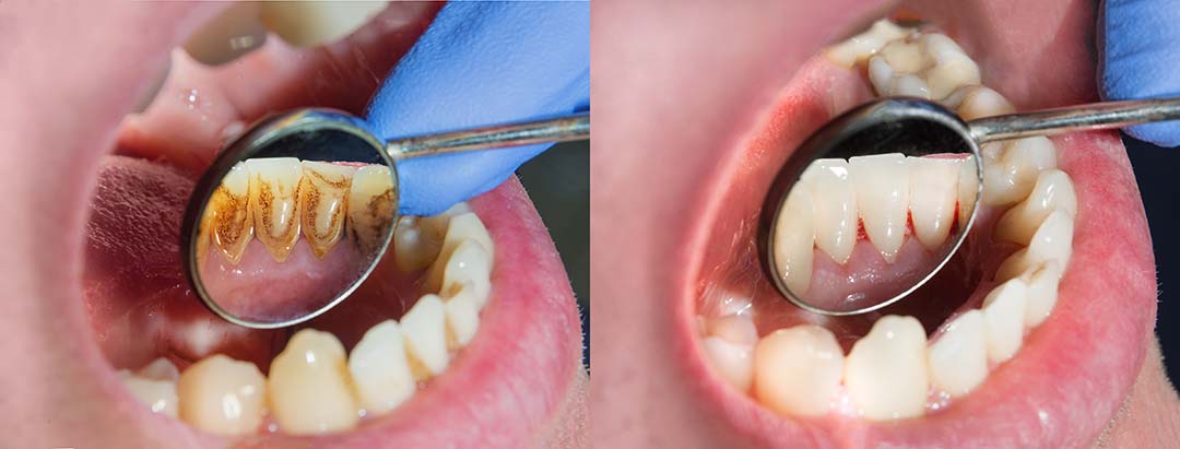 Чистка зубных отложений перед имплантацией зубов