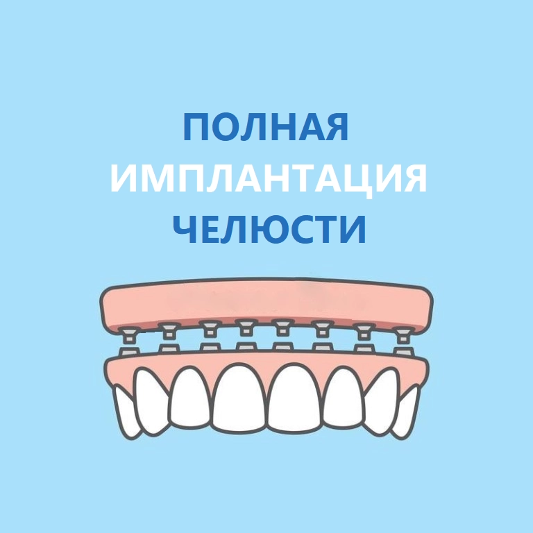Полная имплантация зубов в Москве