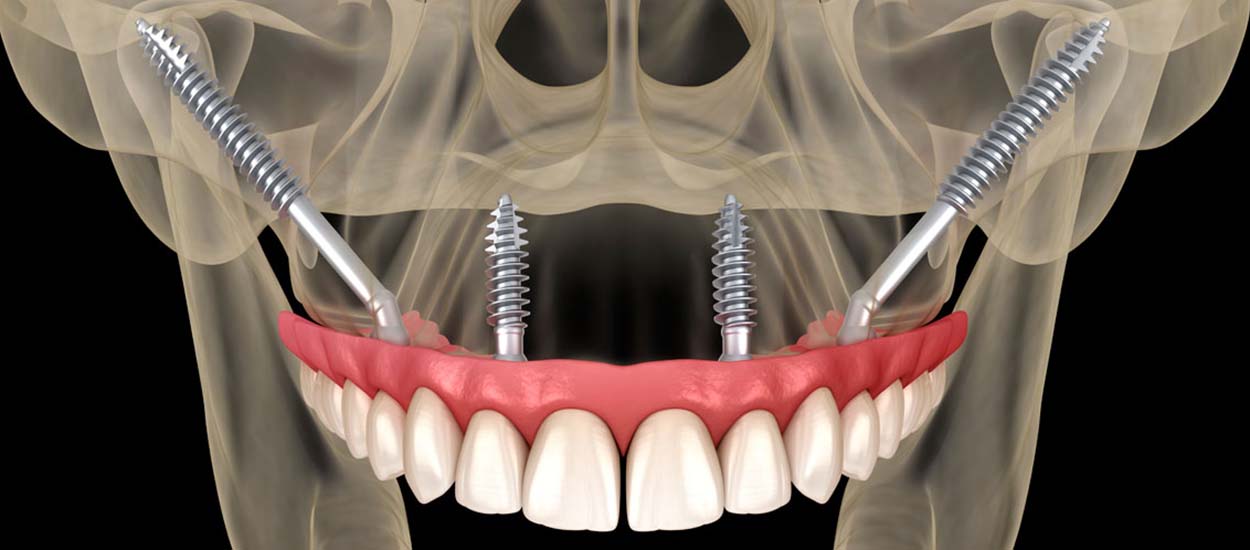 Протезирование зубов с применением скуловой имплантации