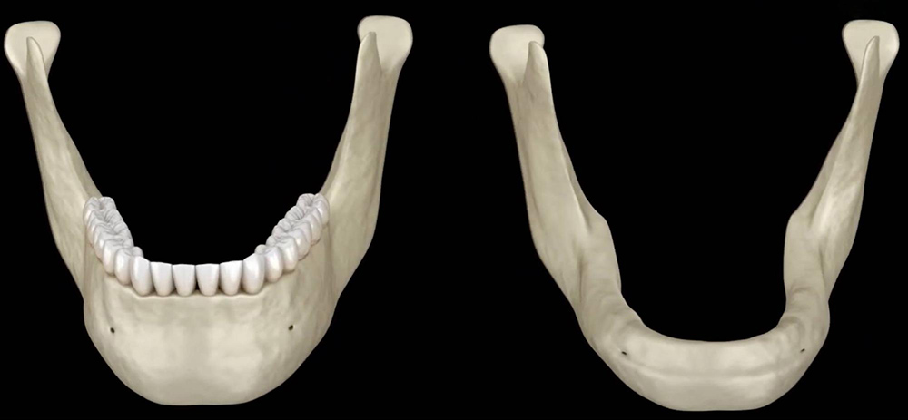 Результат атрофии челюстной кости без зубов