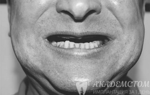 Проблема: у пациента адентия зубов верхней челюсти