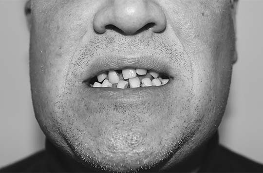 Пациент обратился в клинику Академстом с проблемами нарушения роста и отсутствия множества зубов