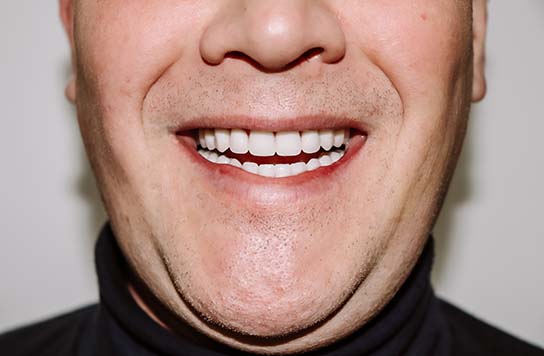 Красивая улыбка после скуловой имплантации нижней челюсти и All-on-4 для нижней челюсти