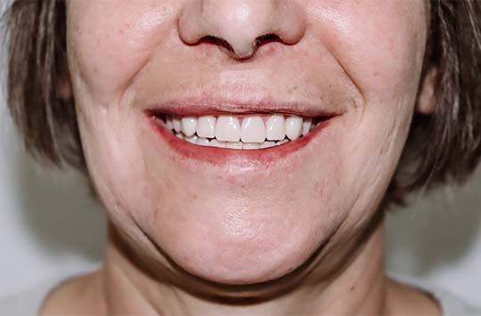 Пациент с новой улыбкой благодаря протезированию на имплантах обеих челюстей