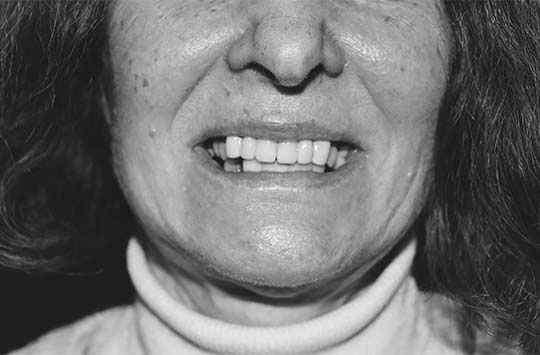 Верхняя и нижняя челюсти с адентией зубов