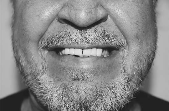 Мужчина нуждался в замене всех зубов обеих челюстей