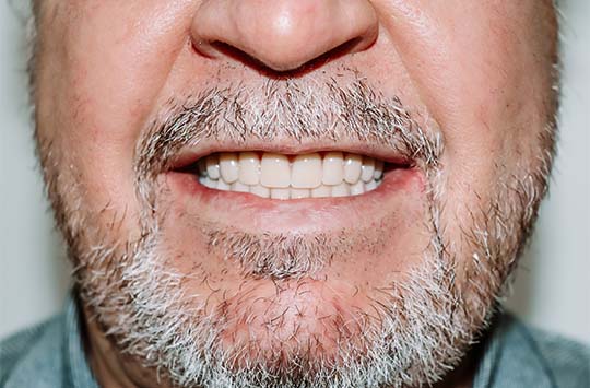 Специалисты клиники Академстом восстановили все зубы по системам «Все на 4» и «Все на 5»