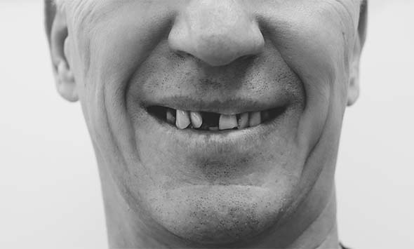 Верхняя челюсть пациента лишена множества зубов