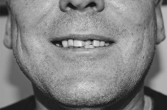 Неудовлетворительное состояние зубов у мужчины