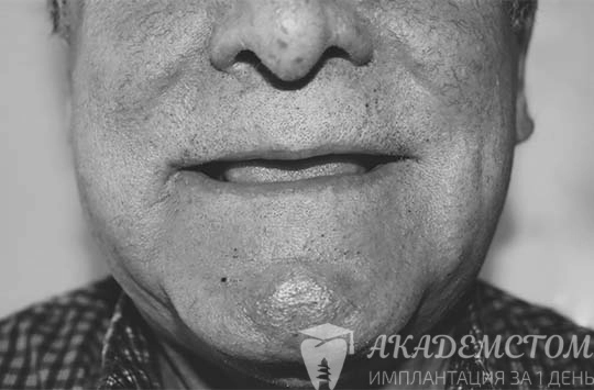 Пациент жаловался на отсутствие всех зубов во рту.