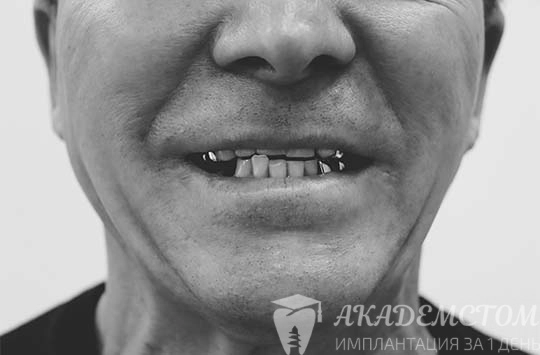Ярко выраженная адентия нижней челюсти и стирание поверхности отсавшихся зубов