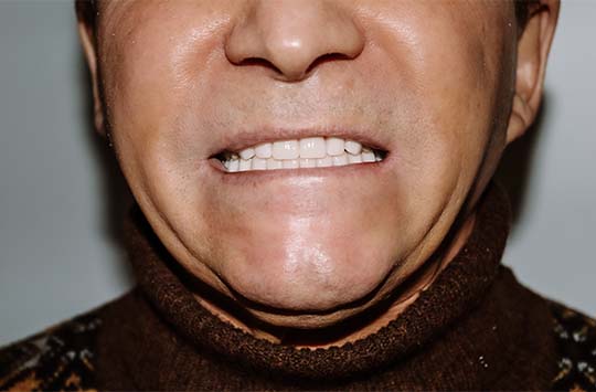 Пациенту установлены новые несъемные протезы на нижнюю и верхнюю челюсти