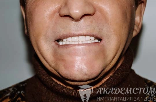 Ярко выраженная адентия нижней челюсти и стирание поверхности отсавшихся зубов