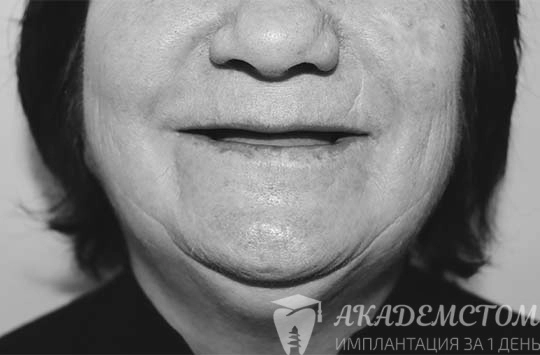 Фото области рта у женщины с адентией