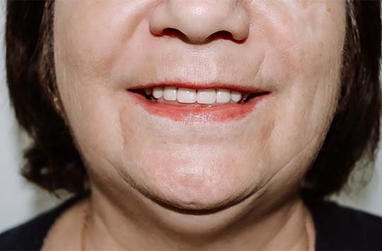 Пациентка снова может широко улыбаться благодаря протезированию